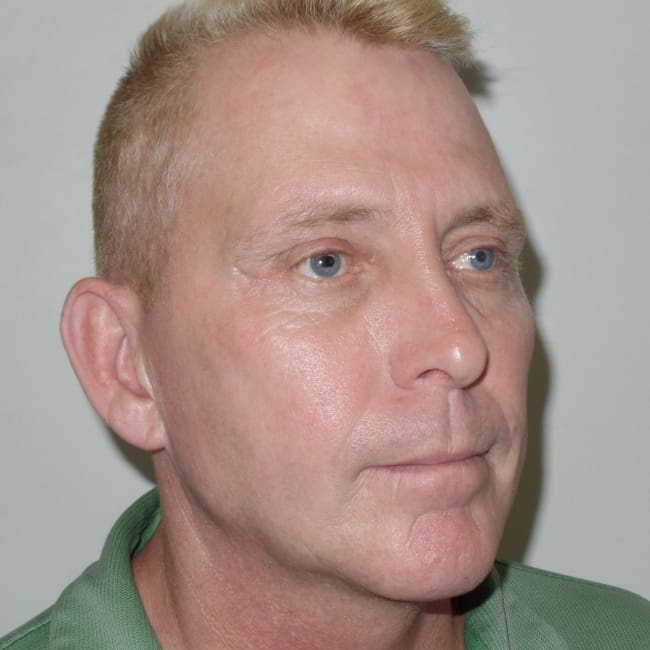 Liquid Facelift Before and After - Case ylift, Image 4 - Male, age 45 – 54 - New York, NY - Dr. Vitolo Plastic Surgery