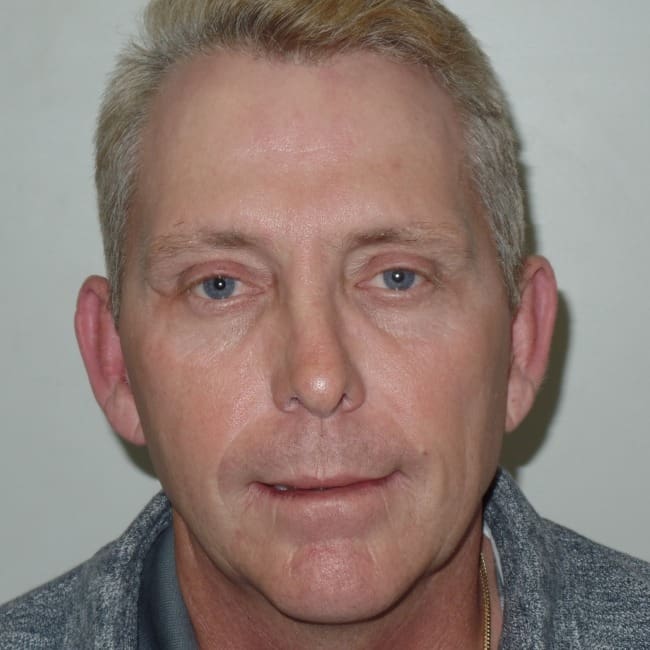 Liquid Facelift Before and After - Case ylift, Image 1 - Male, age 45 – 54 - New York, NY - Dr. Vitolo Plastic Surgery