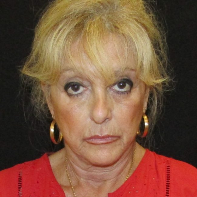 Liquid Facelift Before and After - Case -1, Image 3 - Female, age 55 – 64 - New York, NY - Dr. Vitolo Plastic Surgery