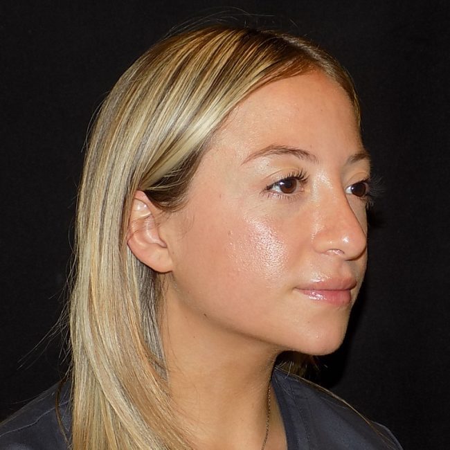 Rhinoplasty Before and After - Case 10, Image 2 - Female, age 25 – 34 - New York, NY - Dr. Vitolo Plastic Surgery