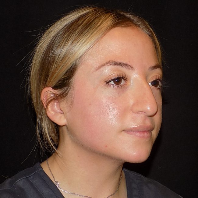 Rhinoplasty Before and After - Case 10, Image 1 - Female, age 25 – 34 - New York, NY - Dr. Vitolo Plastic Surgery
