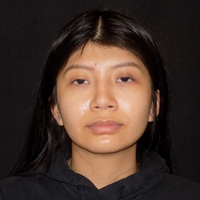 Rhinoplasty Before and After - Case 15, Image 4 - Female, age 25 – 34 - New York, NY - Dr. Vitolo Plastic Surgery