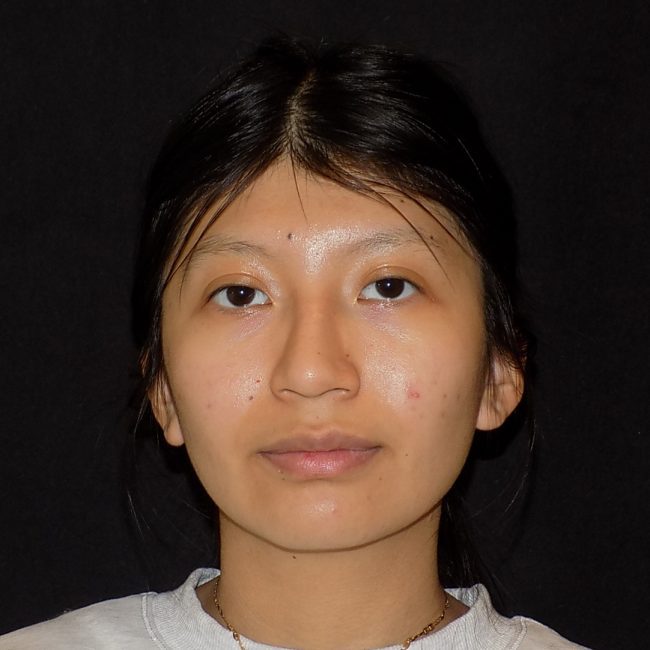 Rhinoplasty Before and After - Case 15, Image 3 - Female, age 25 – 34 - New York, NY - Dr. Vitolo Plastic Surgery