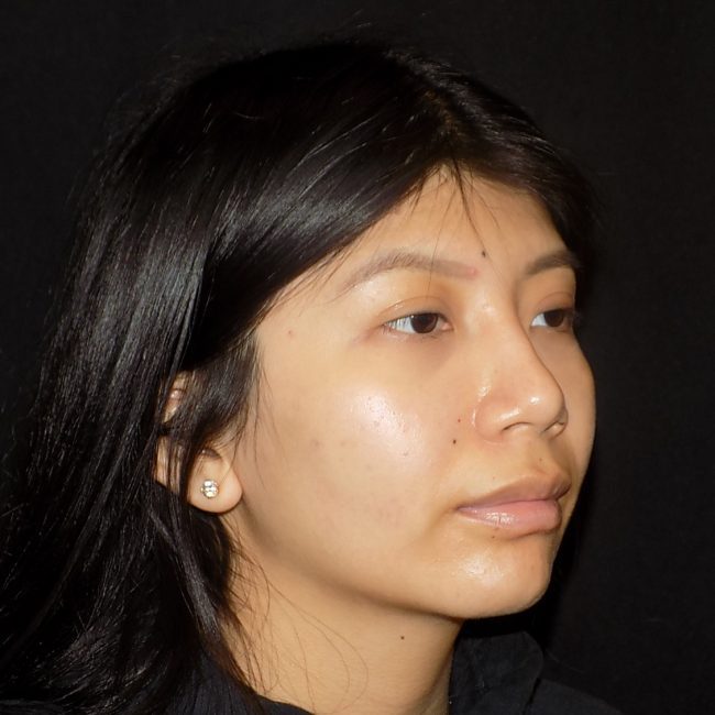 Rhinoplasty Before and After - Case 15, Image 6 - Female, age 25 – 34 - New York, NY - Dr. Vitolo Plastic Surgery