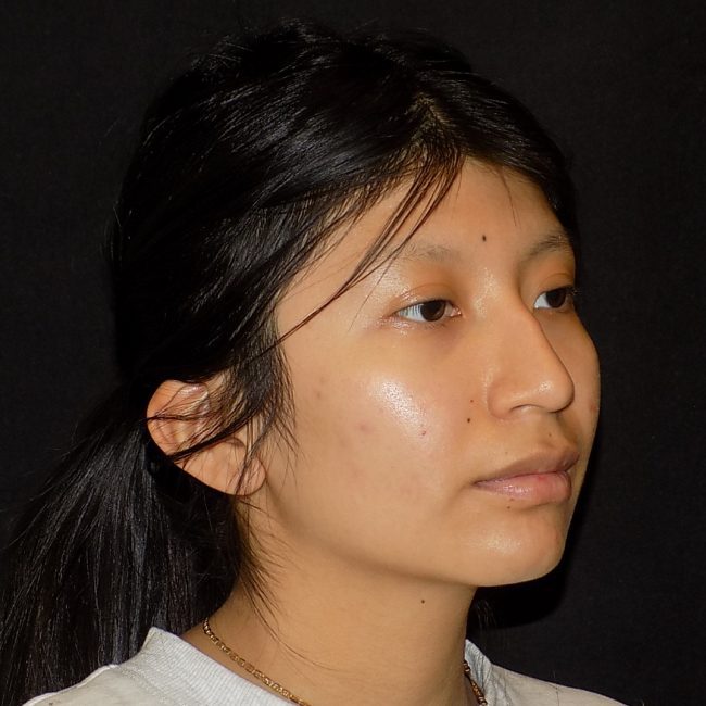 Rhinoplasty Before and After - Case 15, Image 5 - Female, age 25 – 34 - New York, NY - Dr. Vitolo Plastic Surgery