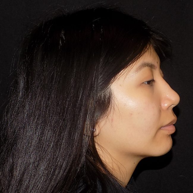 Rhinoplasty Before and After - Case 15, Image 2 - Female, age 25 – 34 - New York, NY - Dr. Vitolo Plastic Surgery