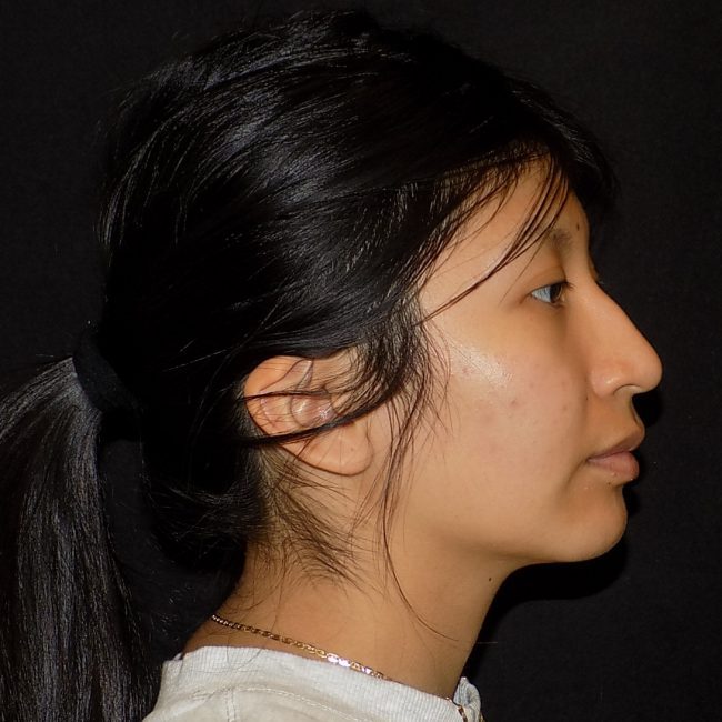 Rhinoplasty Before and After - Case 15, Image 1 - Female, age 25 – 34 - New York, NY - Dr. Vitolo Plastic Surgery