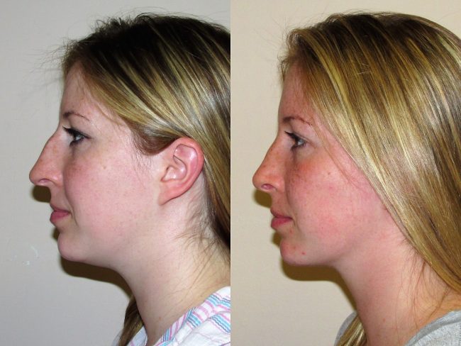 Rhinoplasty Before and After - Case 14, Image 3 - Female, age 25 – 34 - New York, NY - Dr. Vitolo Plastic Surgery
