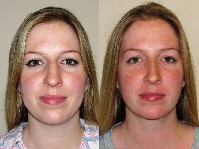 Rhinoplasty Before and After - Case 14, Image 1 - Female, age 25 – 34 - New York, NY - Dr. Vitolo Plastic Surgery
