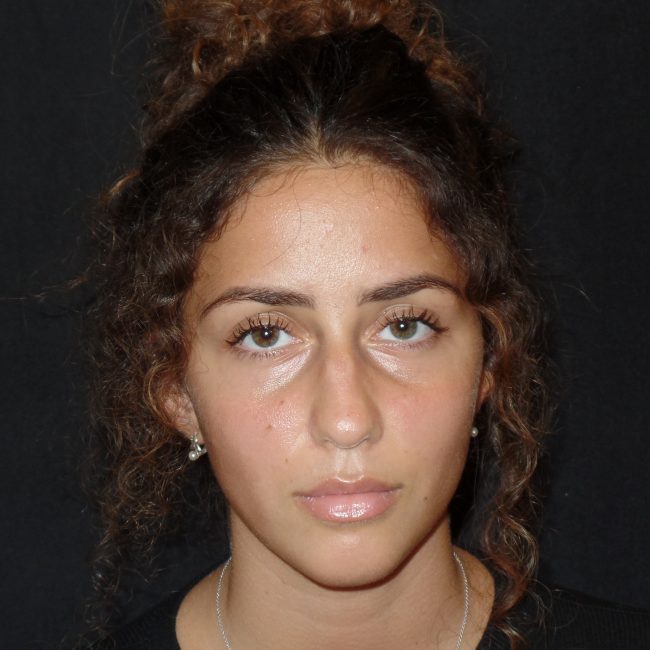 Rhinoplasty Before and After - Case 8, Image 5 - Female, age 25 – 34 - New York, NY - Dr. Vitolo Plastic Surgery