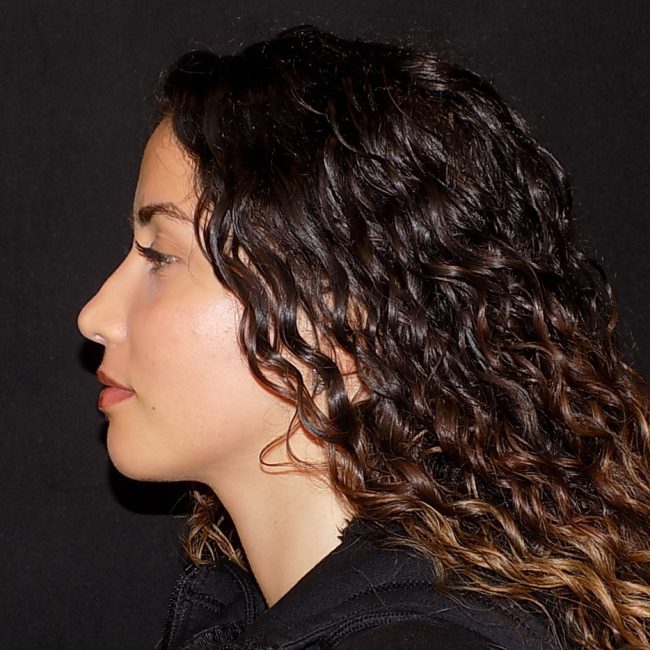 Rhinoplasty Before and After - Case 8, Image 4 - Female, age 25 – 34 - New York, NY - Dr. Vitolo Plastic Surgery