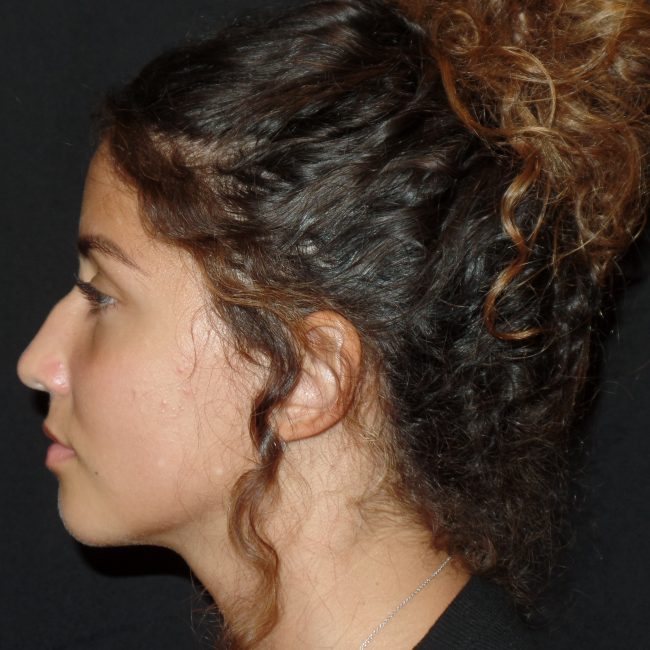 Rhinoplasty Before and After - Case 8, Image 3 - Female, age 25 – 34 - New York, NY - Dr. Vitolo Plastic Surgery