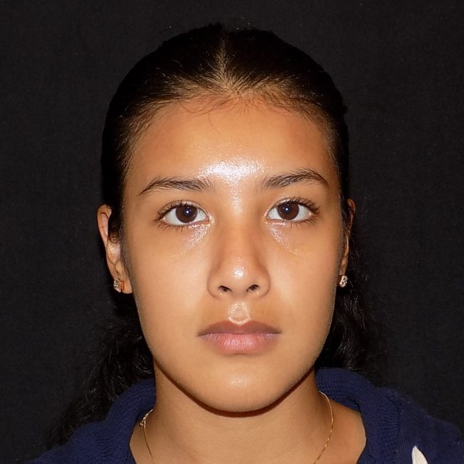 Rhinoplasty Before and After - Case 13, Image 2 - Female, age 18 – 24 - New York, NY - Dr. Vitolo Plastic Surgery
