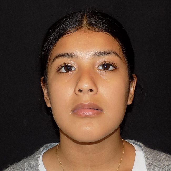 Rhinoplasty Before and After - Case 13, Image 1 - Female, age 18 – 24 - New York, NY - Dr. Vitolo Plastic Surgery